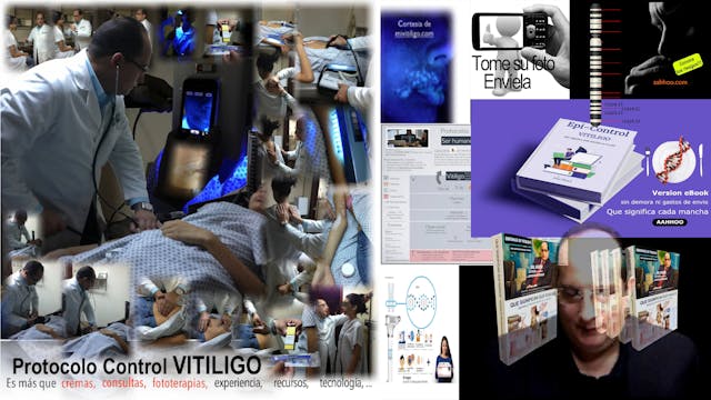 VITILIGO Epi-control videos