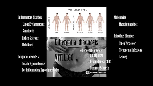Differential Diagnosis Piebaldism