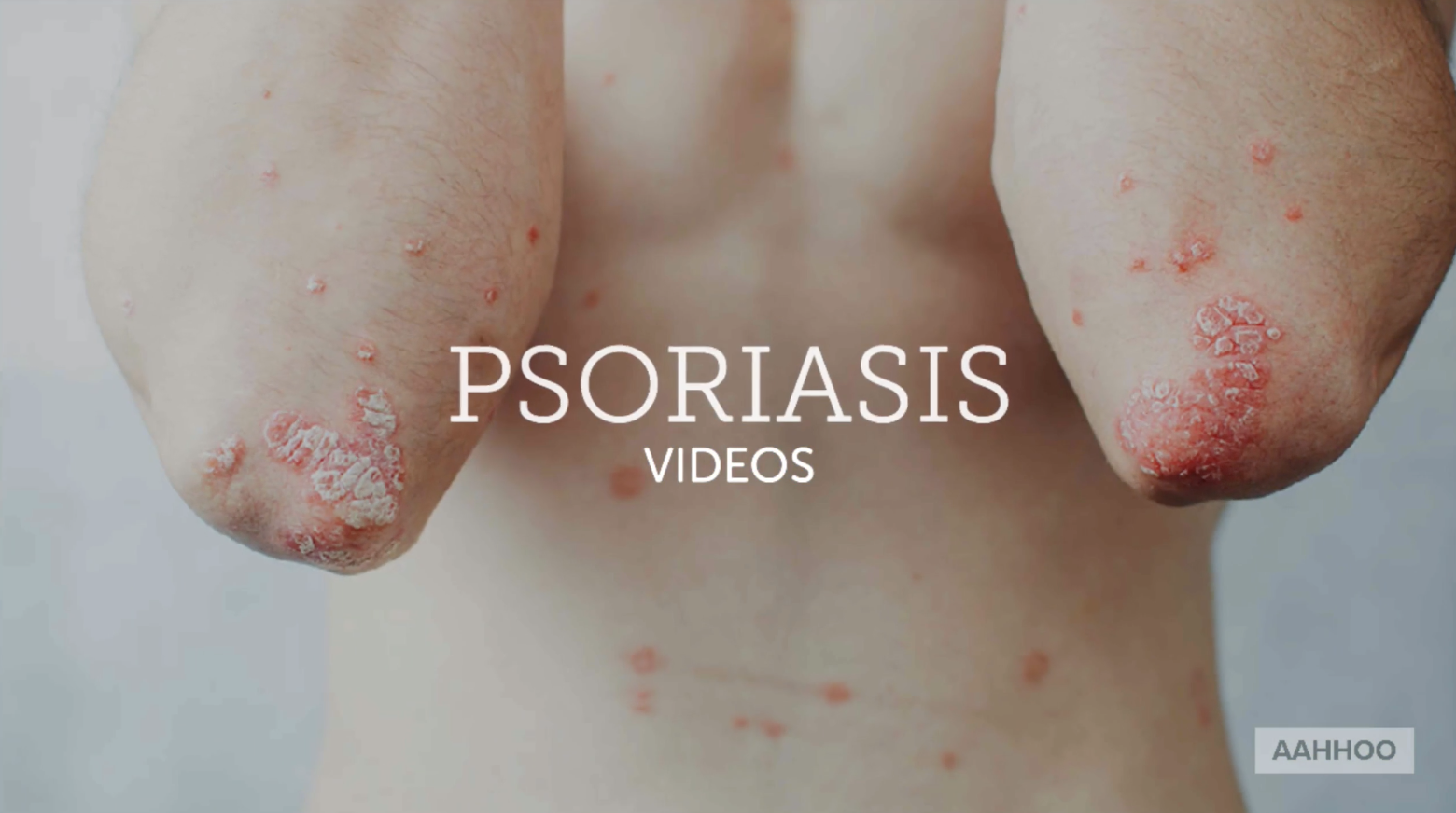 PSORIASIS