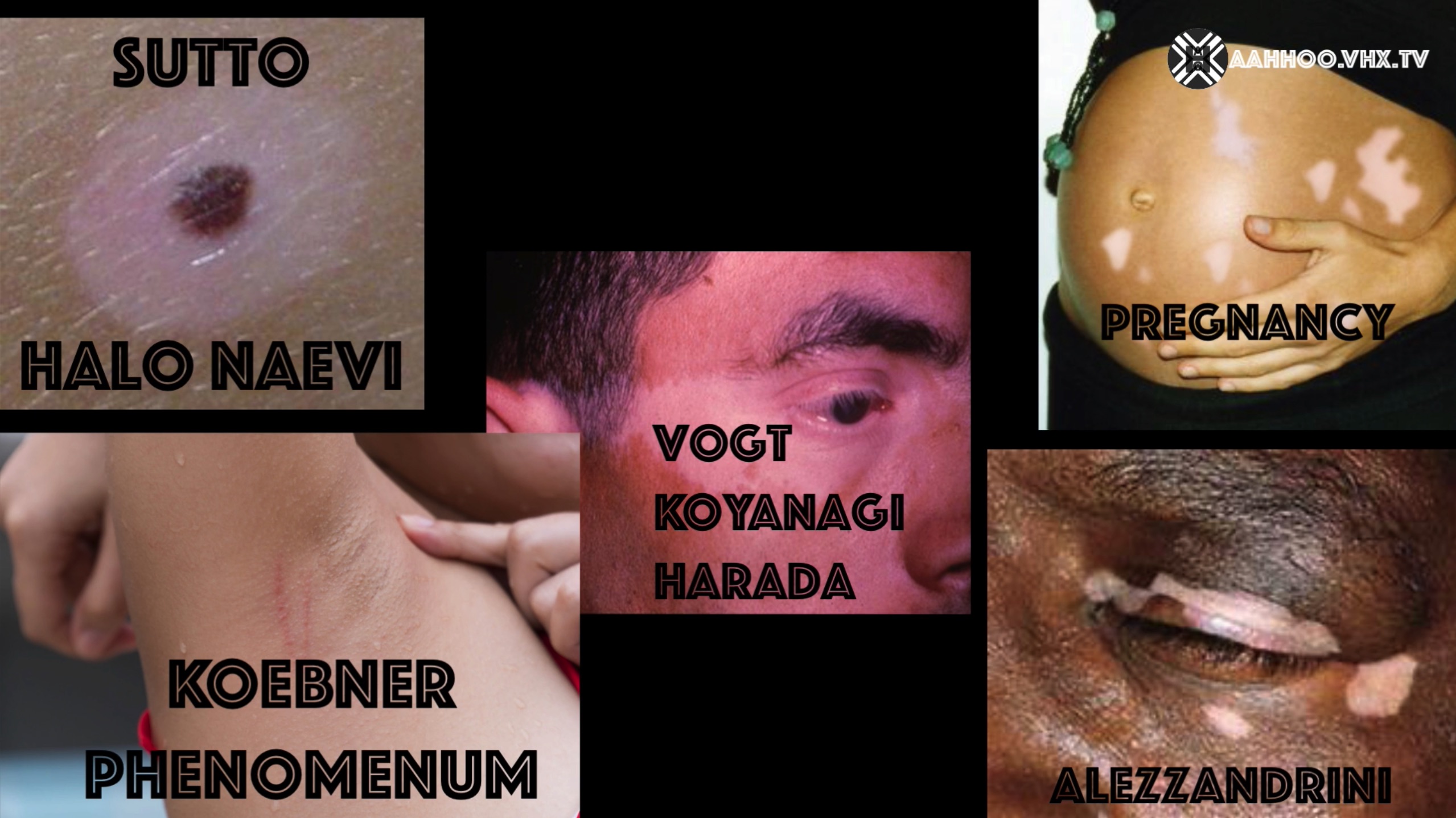 ENIGMAS OF VITILIGO Fifth question