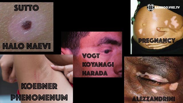 ENIGMAS OF VITILIGO Fifth question