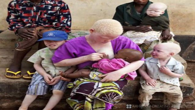 Albinos en Tanzania