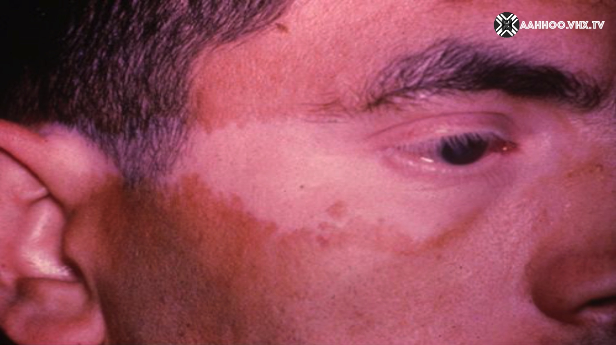 ENIGMAS OF VITILIGO Third question