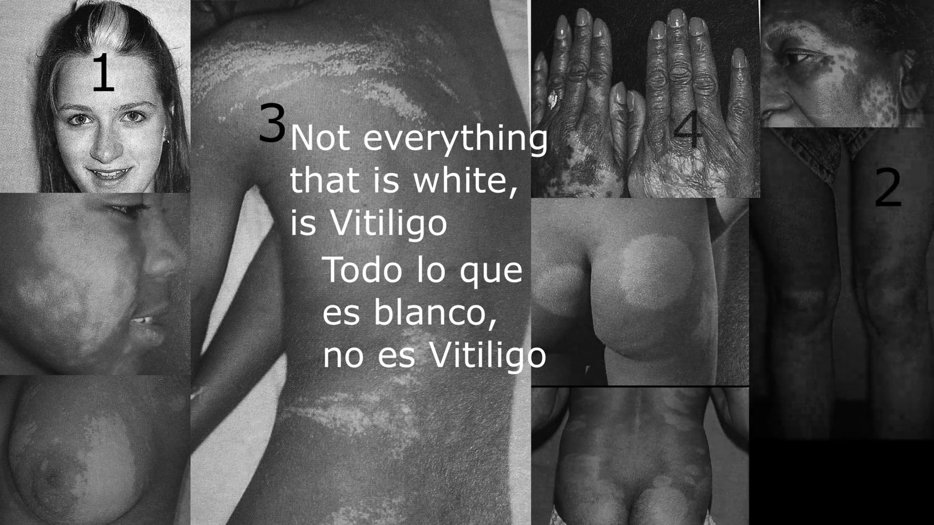 Not everything that is white is Vitiligo