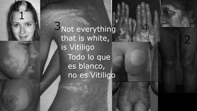 Not everything that is white is Vitiligo