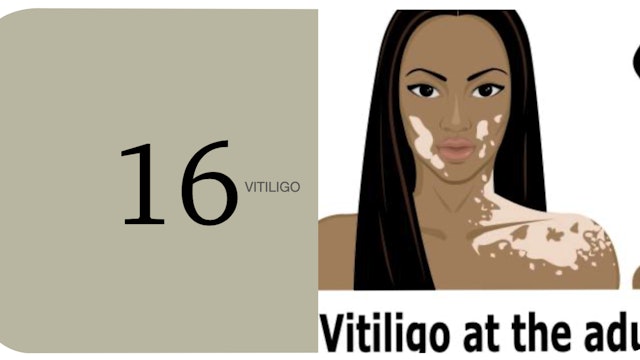 Proyecto Vitiligo