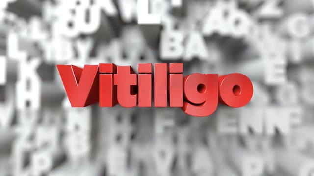 Vitiligo and number 8