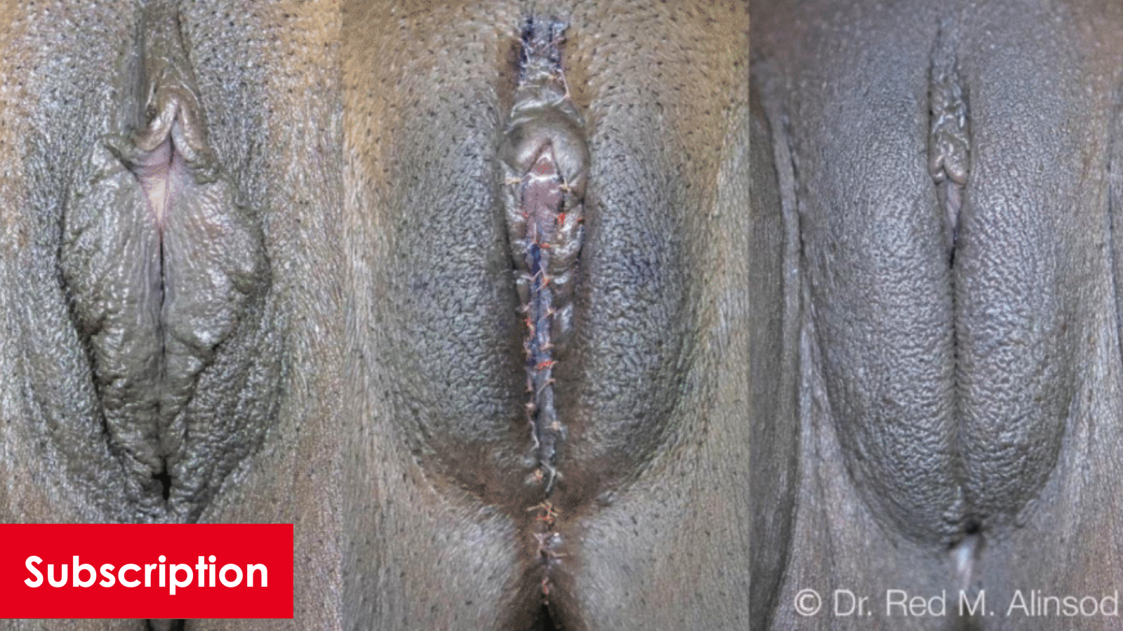 Vampire Wing Lift and Mons Pubis Lift with Larger Volume HA