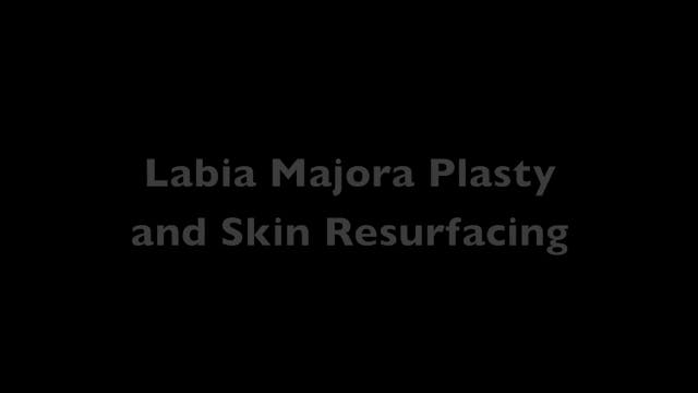 Labioplastia de los labios mayores co...