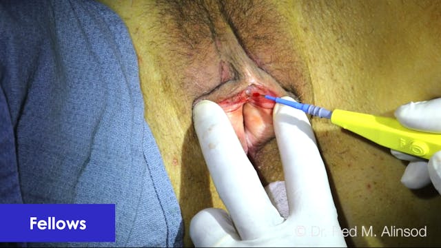 Clitoral Hood Release for Buried Clitoris