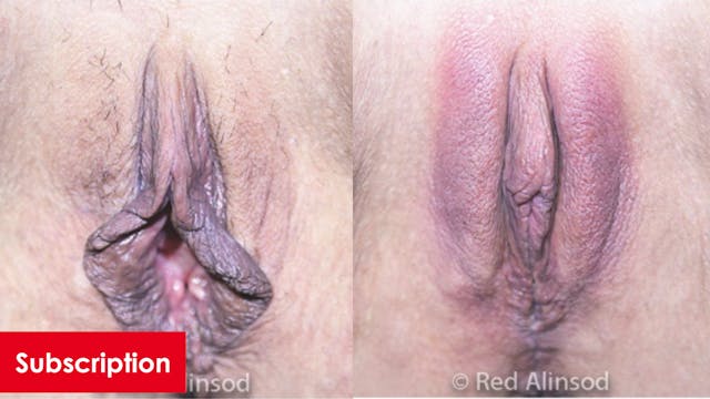 Hybrid Labiaplasty with Vampire Wing Lift and ThermiVa
