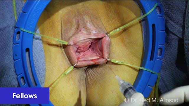 Vaginoplasty, Perineoplasty, Feathering Revision of Dog Ears 