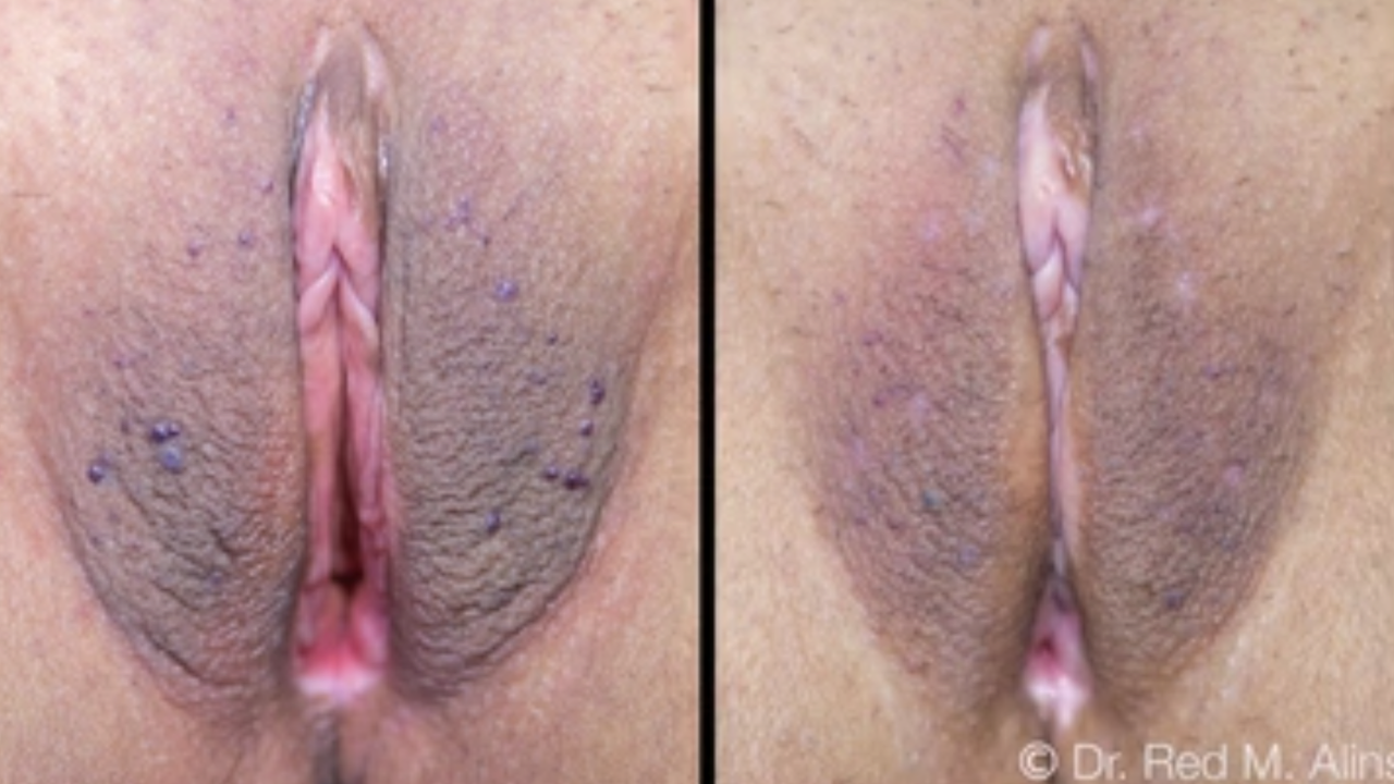 SHORTS: AIAVS Fellows, Management of Vulvar Angiomas, LS, GSM, Anal Skin Tag