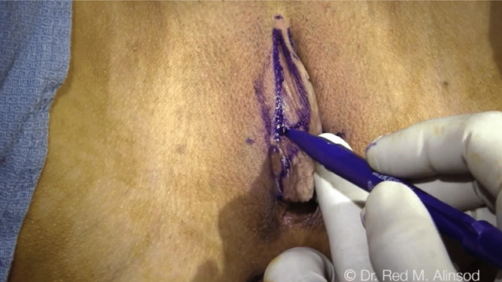 Clitoral Hood Reduction: Lateral and Vertical Approaches