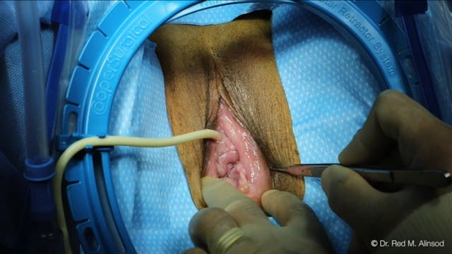 SHORT: #4 Final - Transvaginal Uterine Suspension with Audio 15 Min ISCG 2020