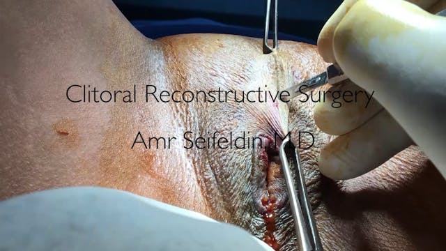 Clitoral Reconstructive Surgery -1 (Amr Seifeldin, M.D)-