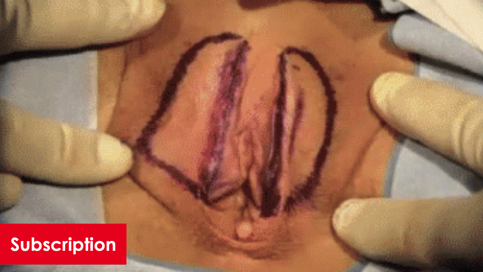 Labiaplasty 101: Primer Aesthetic Gyneocologic Energy Based Devices & Biologics