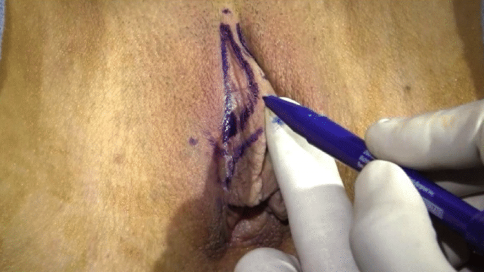Lateral Clitoral Hood Reduction