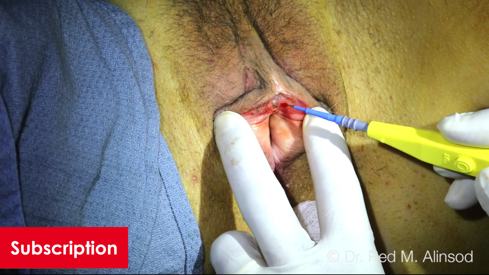 Clitoral Hood Release for Buried Clitoris