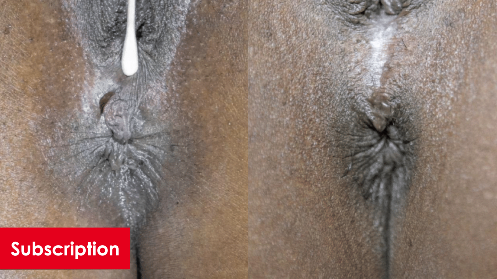 Perineoplasty and Excision of External Anal Skin Tags