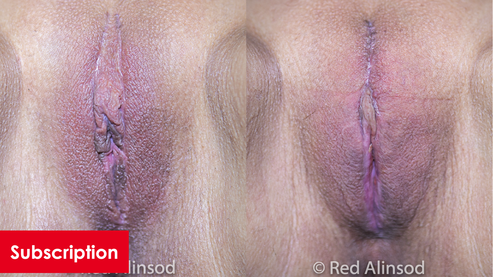 Vertical Clitoral Hood Revision, Feathering Revision, O-Shot,  and VWL