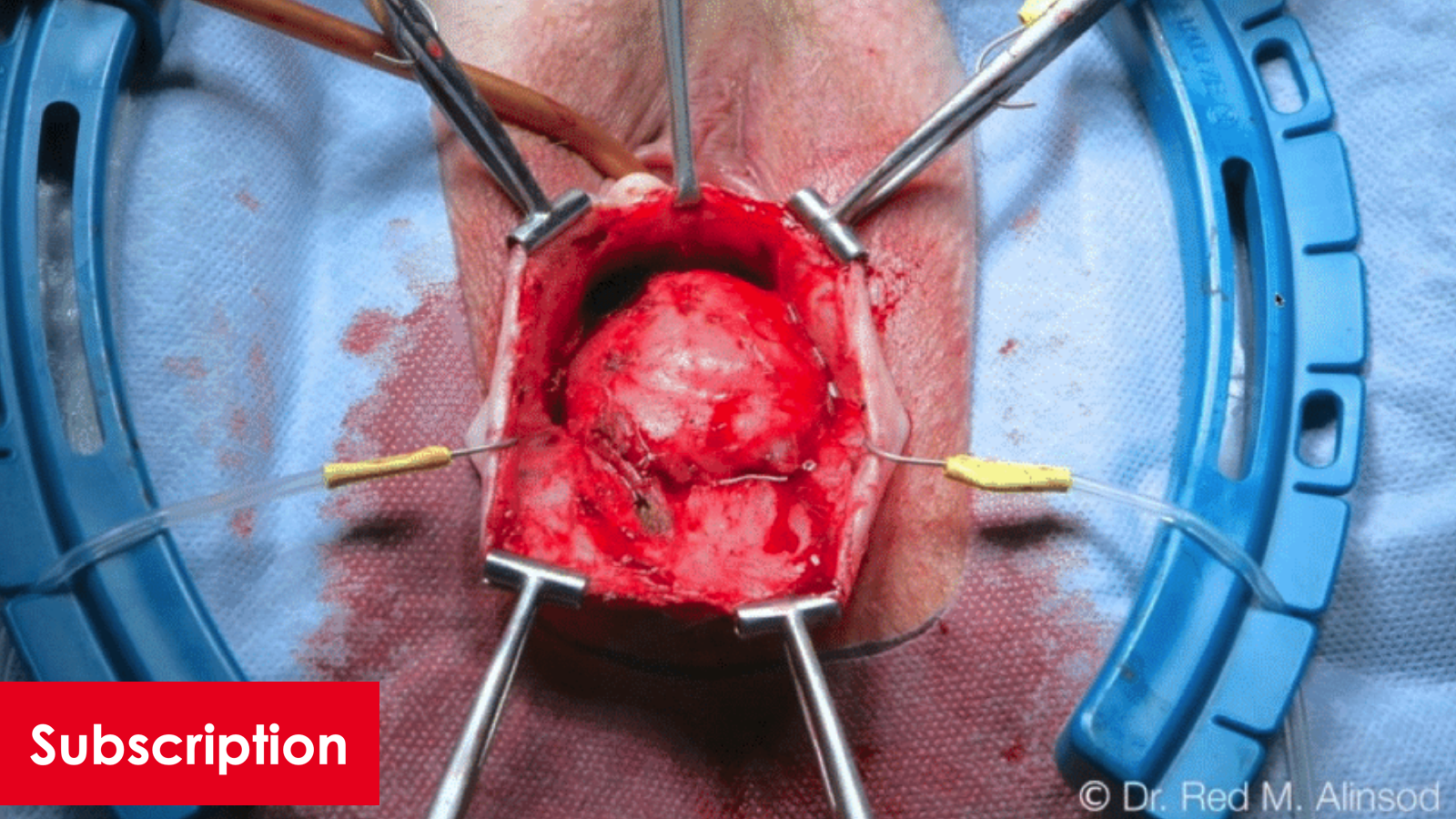 TOT, Anterior Repair with Dermis, and Transvaginal Uterine Suspension