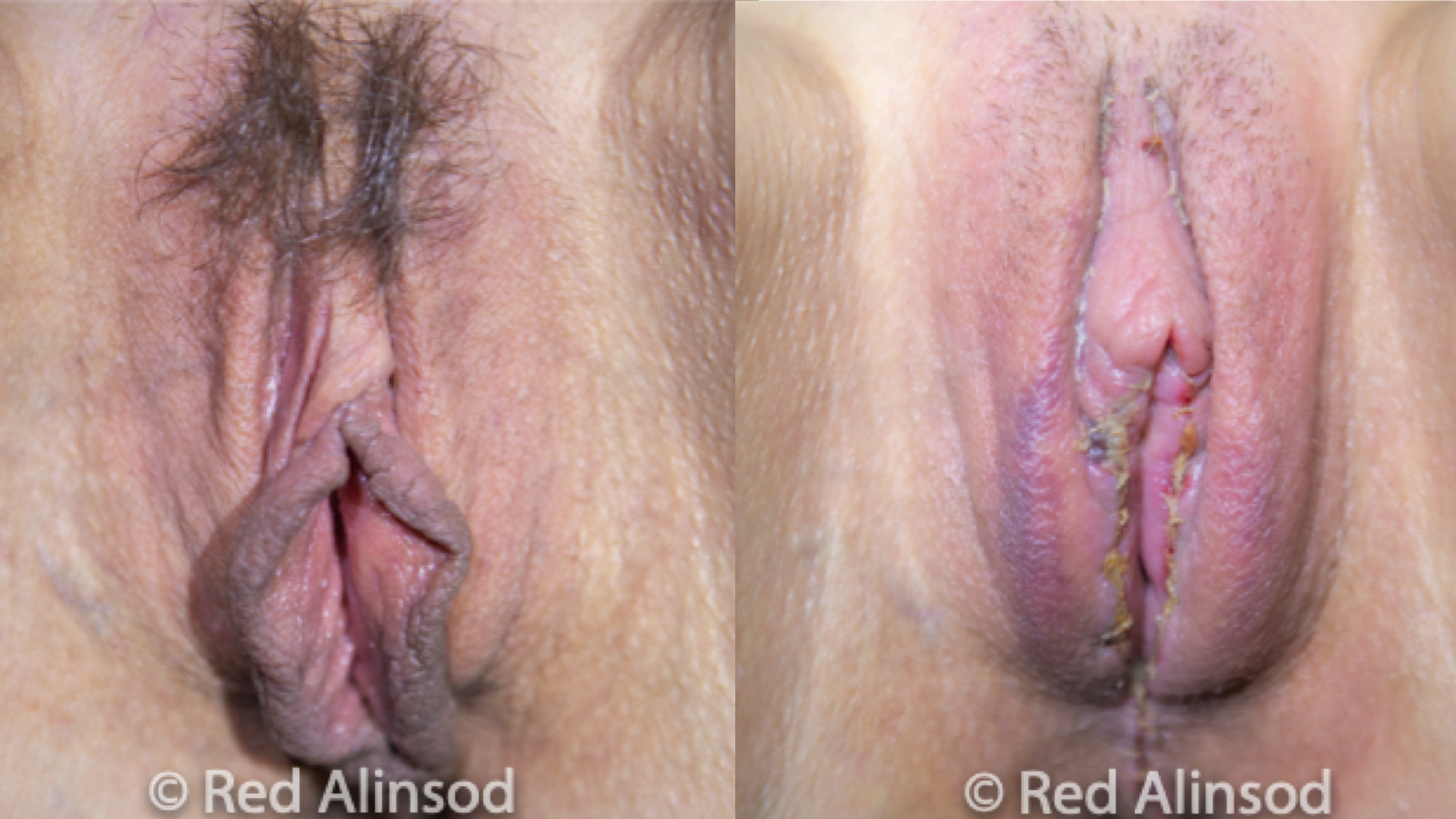 Barbie Labiaplasty with Clitoral Hood Reduction, and A Incision Steps