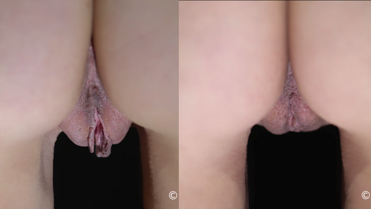 SHORTS: Perineoplasty w/ Labiaplasty Revision for Gaping, Medial Labial Excision