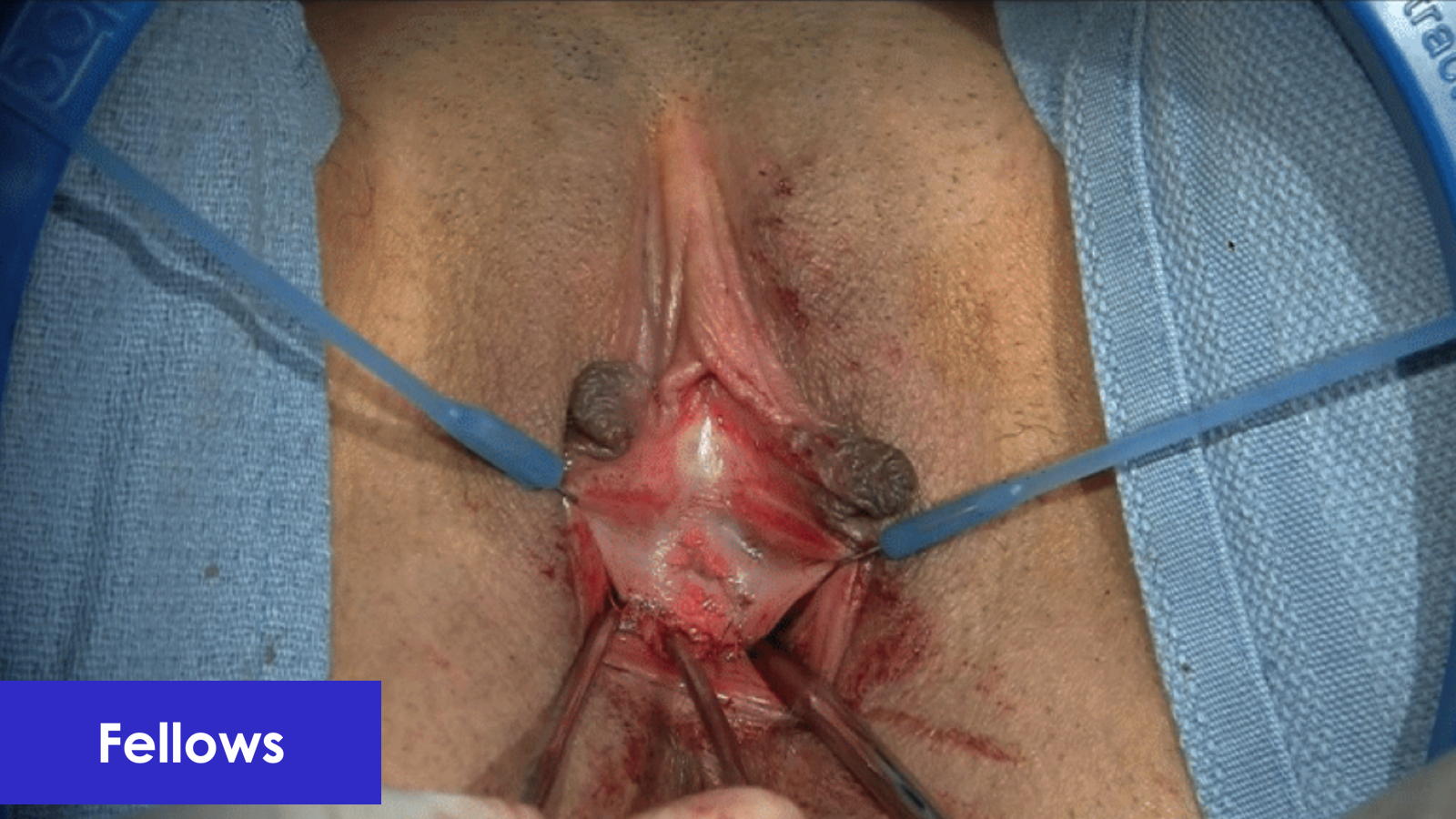 Cheat Sheet - Hymenoplasty PIllar Technique