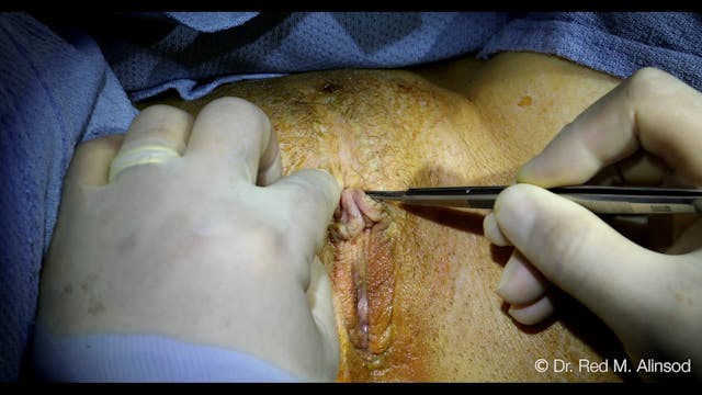 AIAVS Fellows Video 106,  Live Narrated Clitoral Bulb Reduction and Frenulectormy with CHR Revision 