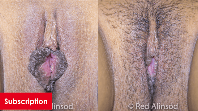 Hybrid Labiaplasty with Unipolar and Bipolar Radiofrequency