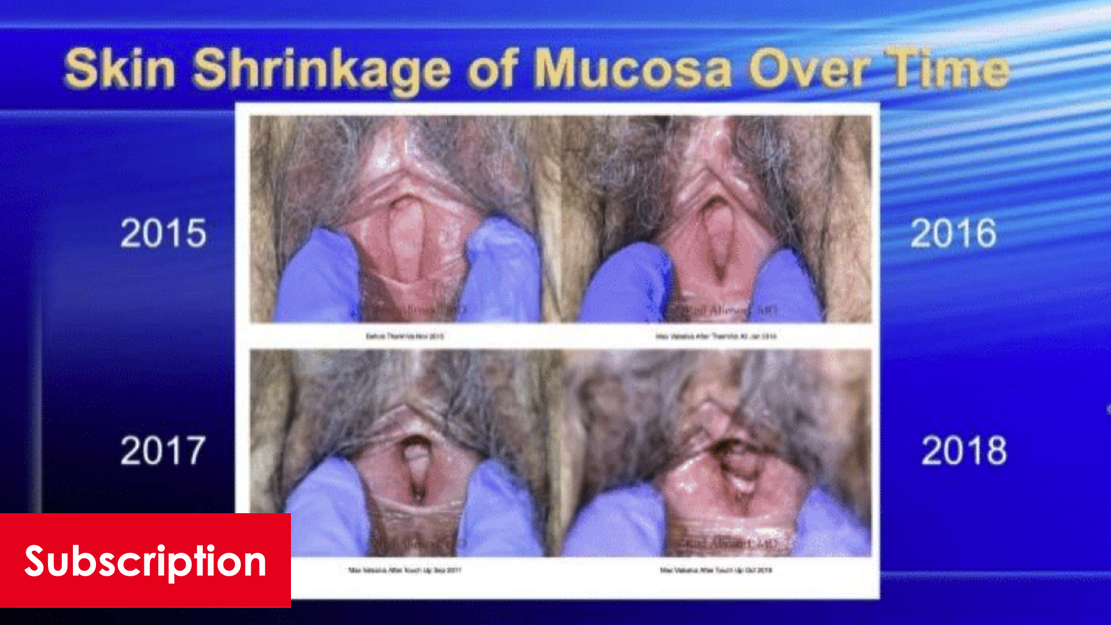 ThermiVa in Gynecology: A Six Year Review