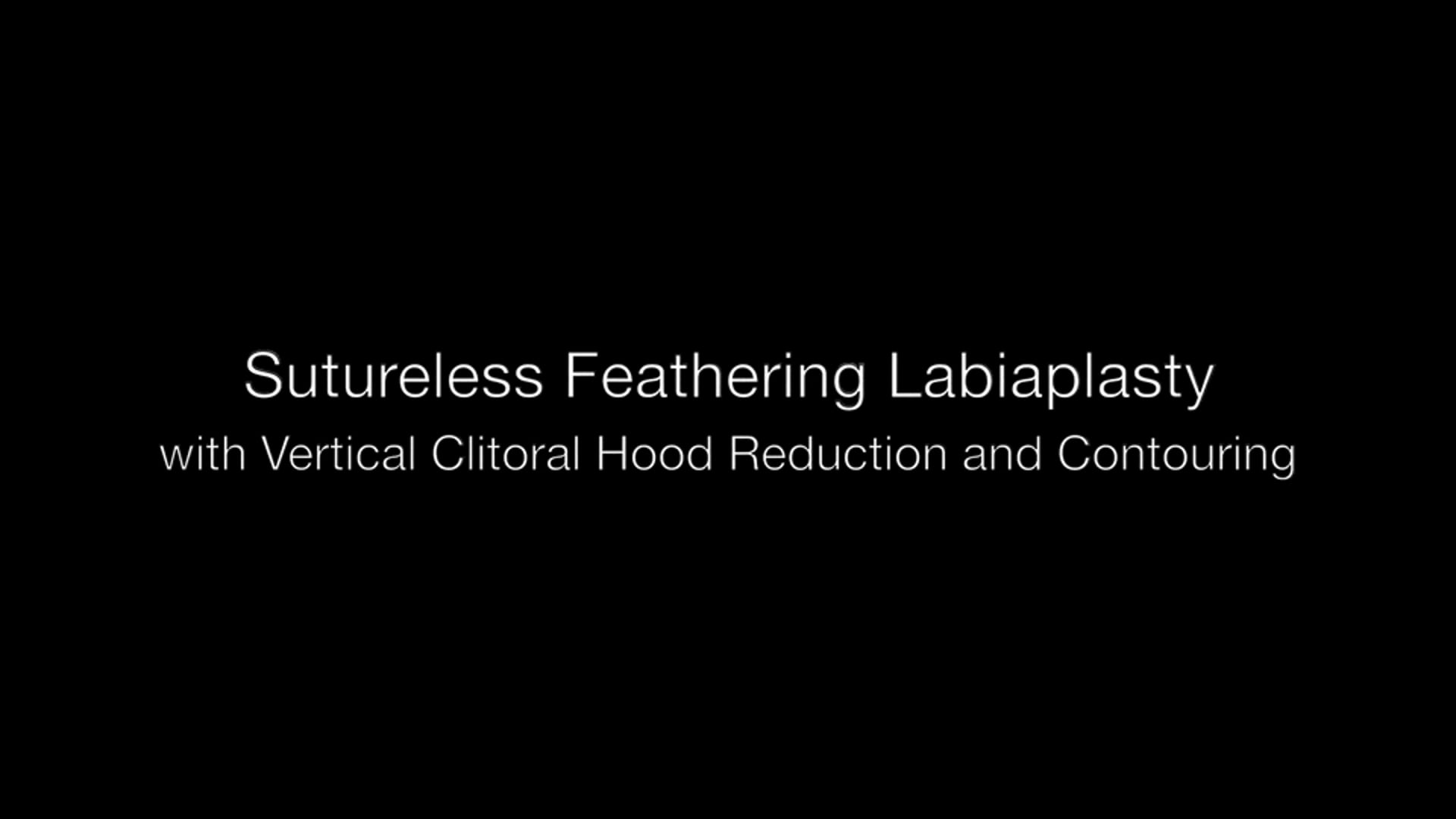 Revisión de labioplastia sin suturas con difuminado, CHR vertical y contorno