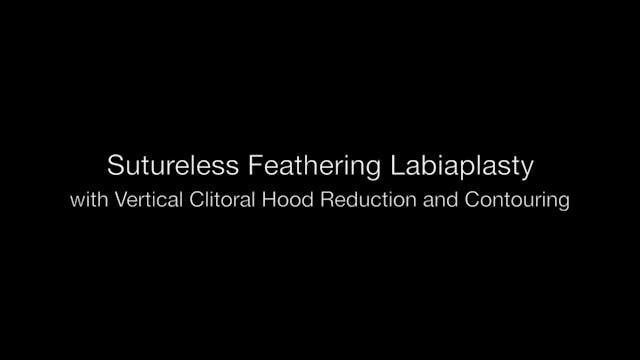 Revisión de labioplastia sin suturas con difuminado, CHR vertical y contorno