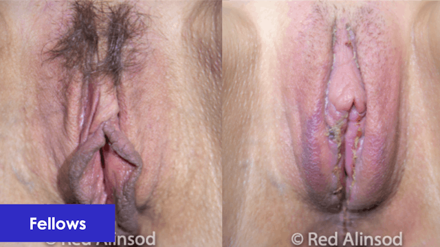 Barbie Labiaplasty with Clitoral Hood Reduction, and A Incision Steps