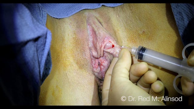 AIAVS Fellows Video 69, Live Narrated Perineoplasty, Wedge Labiaplasty Revision, CHR, O-Shot 4K.m4v