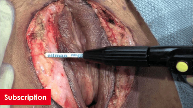 Labia Majoraplasty with Radiofrequency Feathering