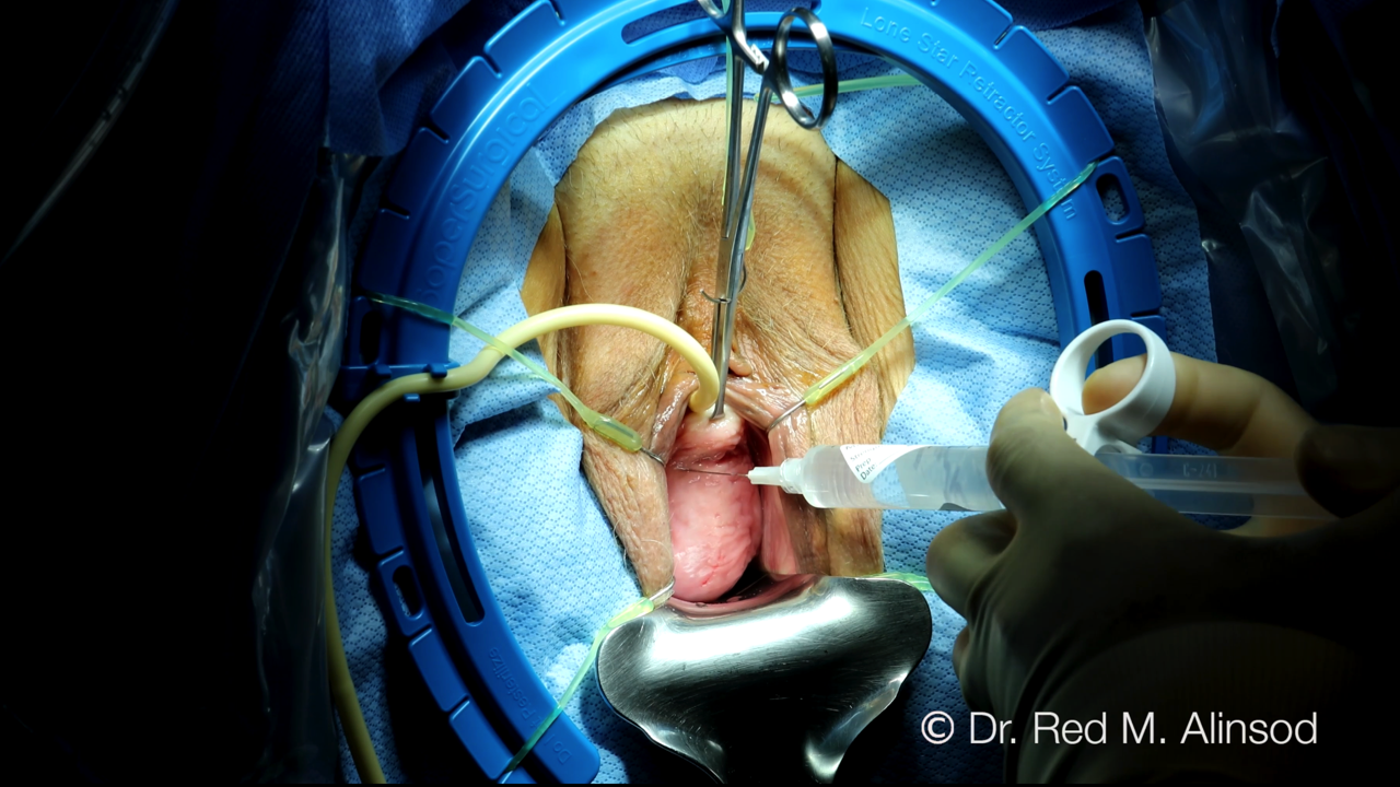 SHORTS: The Renaissance of Augmented Pelvic Floor Repair ISCG Version 2022