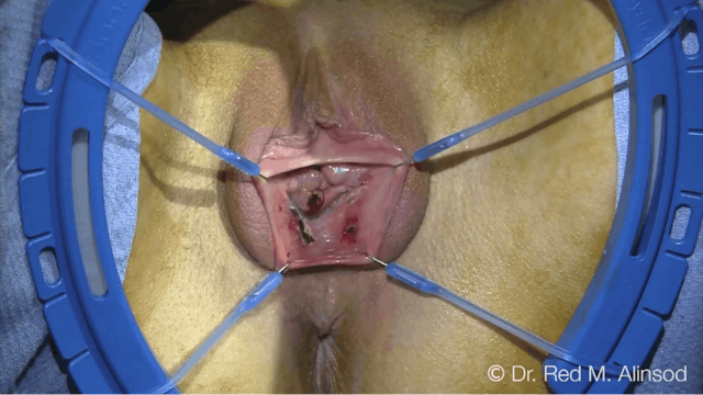 SHORTS: AIAVS Fellows Video 19, Removal of Hymeneal Remnants
