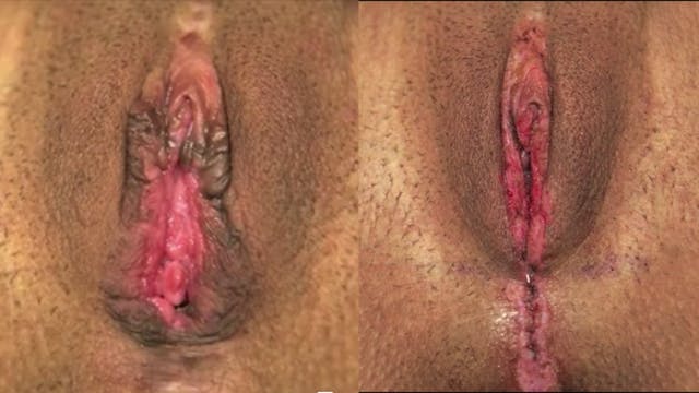 SHORTS: Alinsod 4D Vaginoplasty & Feathering Revision