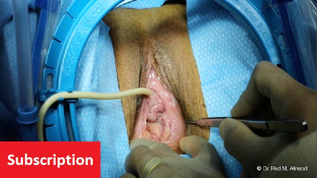 Transvaginal Uterine Suspension: Pelv...