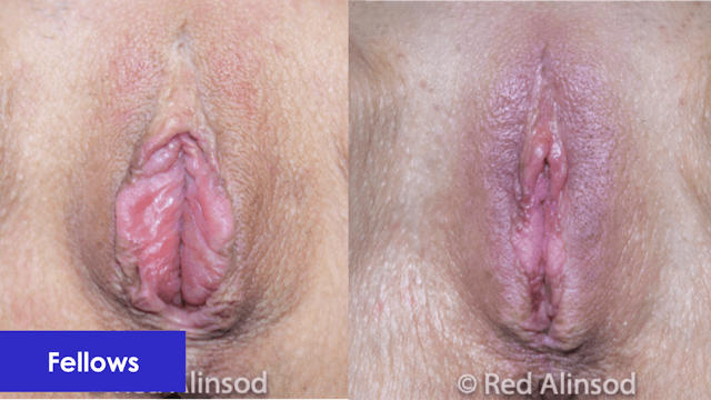 Perineoplasty with Labiaplasty Revision for Gaping Labial Excision