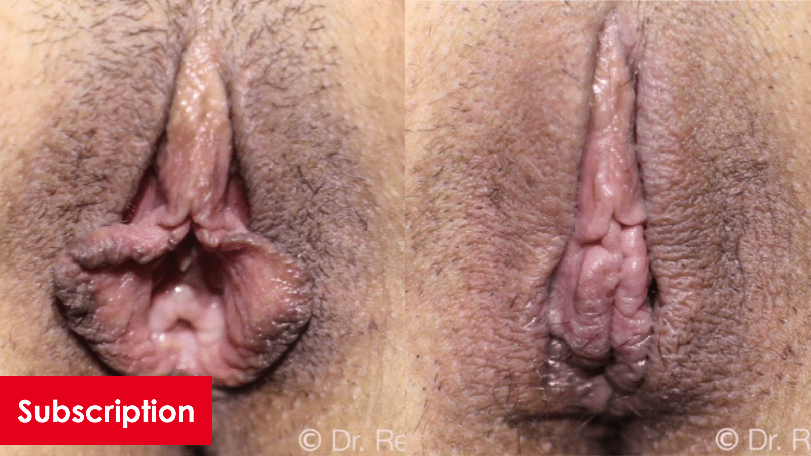 Rim Labiaplasty, Clitoral Hood Reduction, and Perineoplasty