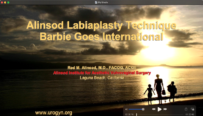 Alinsod Labiaplasty Technique: Barbie Goes International