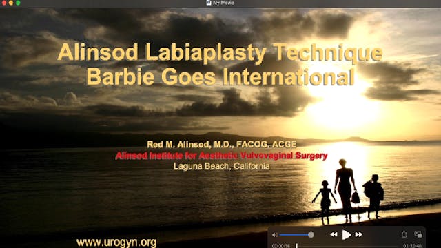 Alinsod Labiaplasty Technique: Barbie Goes International