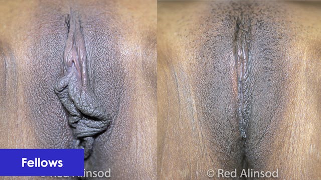 Perineoplasty, Vaginoplasty, Barbie L...