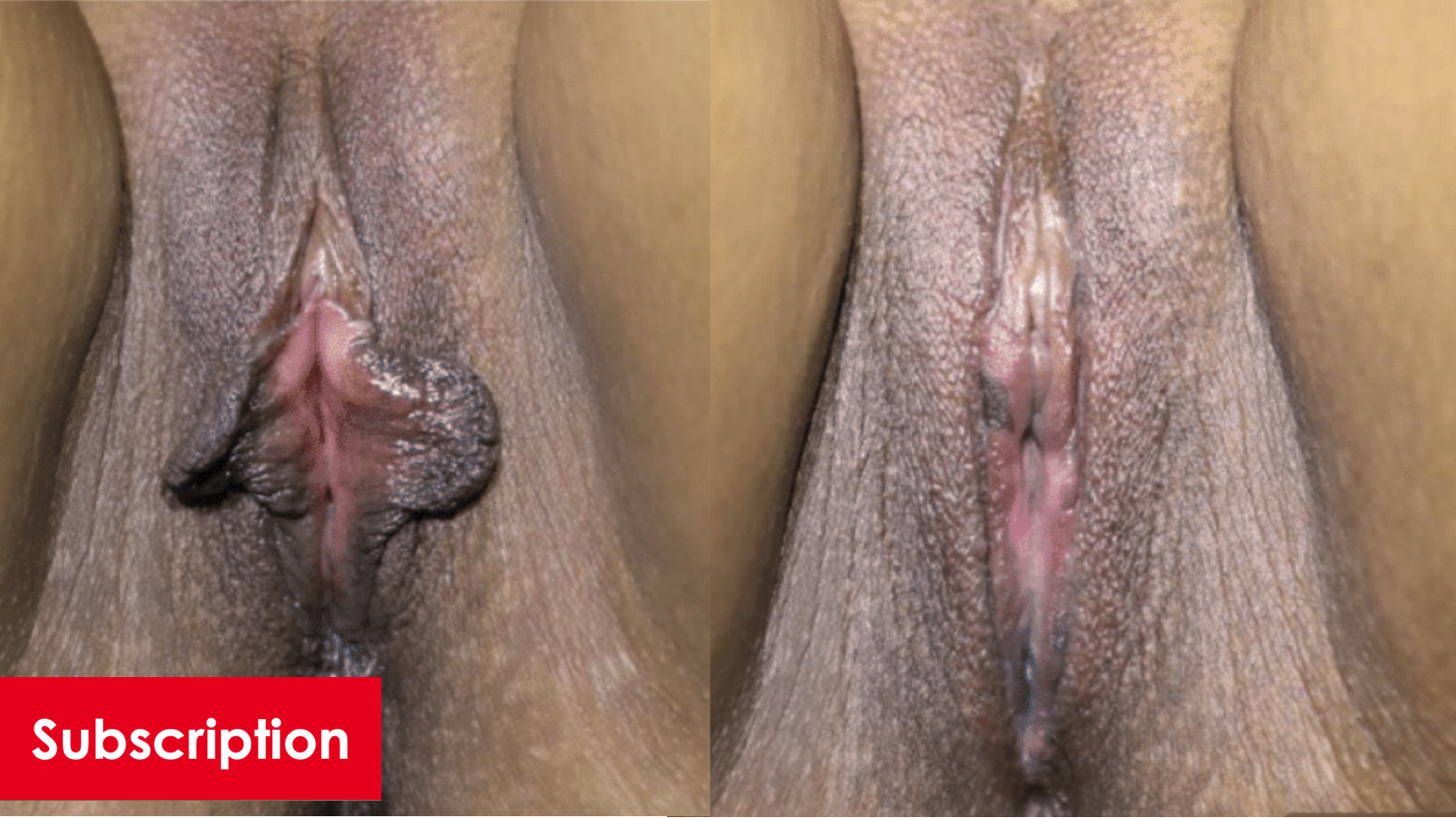 Vaginoplasty, Perineoplasty, Post Rep, MP, Barbie LP, CHR, Anal Skin Tag