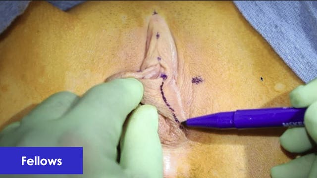 Labia Minoraplasty Anesthesia and Marking: Hybrid and Barbie Look