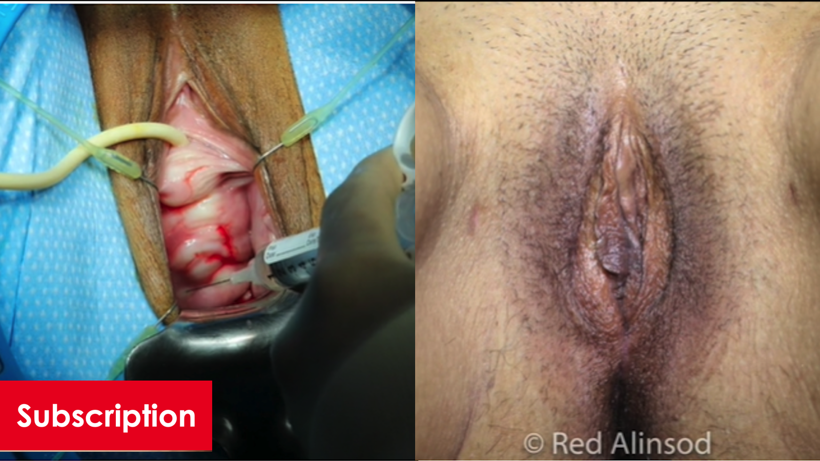Transvaginal Uterine Suspension: Pelvic Reconstruction with Dermal Augmentation