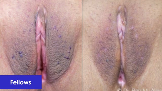 Management of Vulvar Angiomas, Lichen...